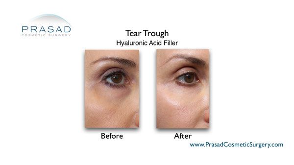 Under Eye Filler for Hollow Eyes, Tear Troughs and Under Eye Bags