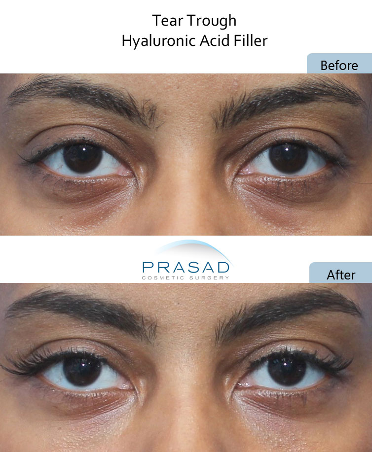 dark under eyes circles treatment with PRP and Filler