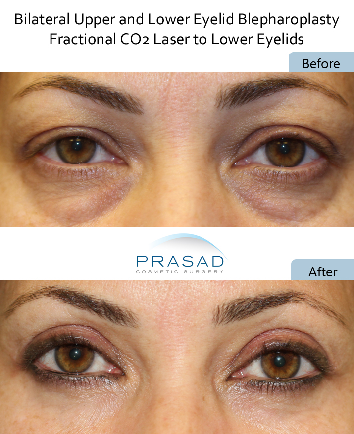 dark under eye circles prp and laser treatment before and after