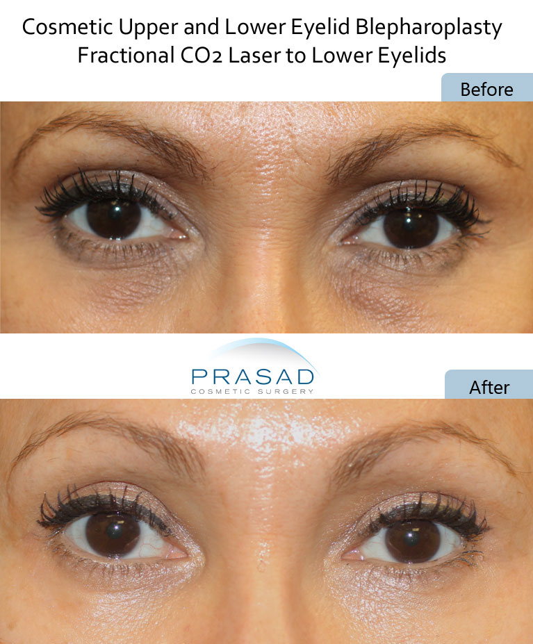 dark circles undereyes treatment with CO2 Laser