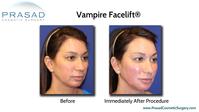 Vampire Facelift performed by Dr Amiya Prasad, before and immediately after results on female patient
